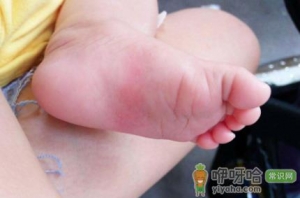 扁平足会不会遗传给孩子