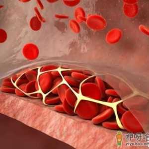 心梗血栓怎么引起的 什么方法能把血栓去掉