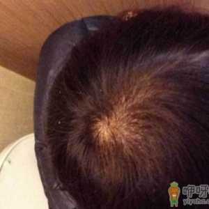 如何预防秃顶掉发 为什么男生比女生容易秃头