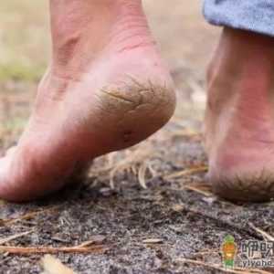 脚后跟干裂起皮是缺什么 脚后跟干裂擦什么滋润