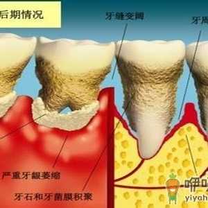 牙周炎会诱发类风湿关节炎