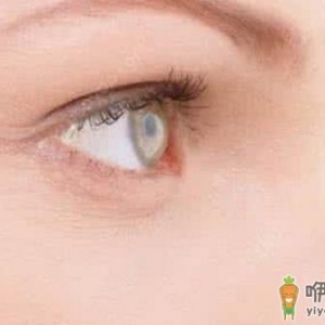 得了红眼病不能吃什么