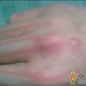 皮肤被烫伤了要如何处理