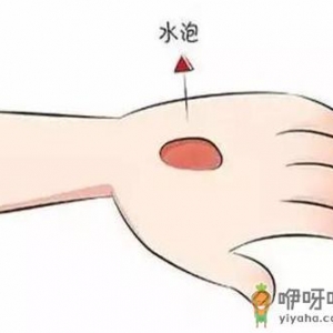 烫伤的水泡能挑破吗 科学处置烧烫伤方法