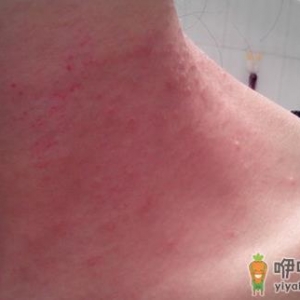 五种方法预防皮炎 两种偏方赶走痛痒