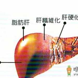 脂肪肝的治疗方法 应酬男应该看看