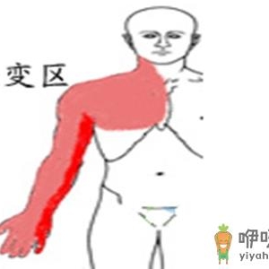 什么是胸廓出口综合征？