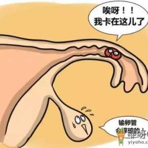 输卵管妊娠的自我检查、症状及治疗方法