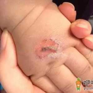 孩子常见的意外损伤类型有哪些？