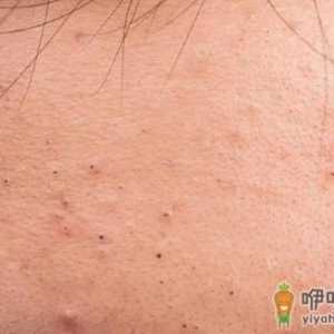 正确处理黑头 弄清楚每个部位长黑头的原因