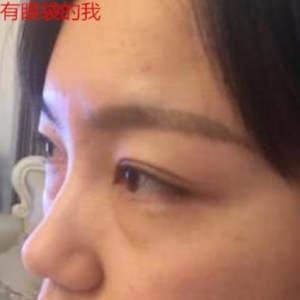 卫娅日记:我一直都以为眼袋对我的影响只是美观,直到我了解以后…… ...