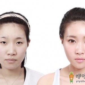 割双眼皮疼吗