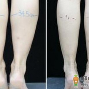 吸脂和打针瘦腿那个效果更好