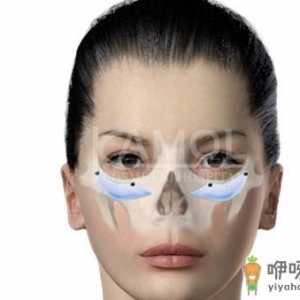 为您介绍下颧骨填充材料的种类