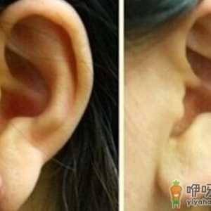 耳垂再造能解决哪些耳垂问题？