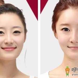 垫下巴有什么效果 会更美吗