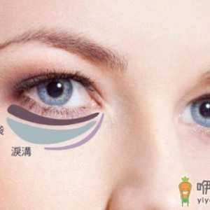 关于眼袋的三大误区 去除眼袋别再做无用功