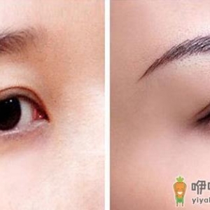 激光洗眉效果十分理想