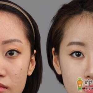 鼻翼整形术前6大禁忌 不可忽视