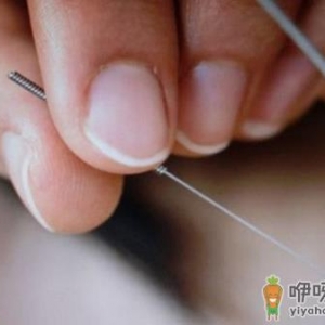 针灸美容帮你内外调节肌肤