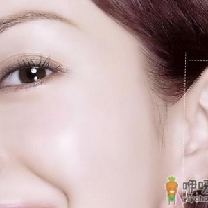 耳部整形手术注意事项