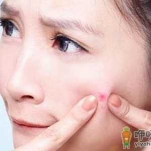 脸上各种“粉刺”的区别和应对方法