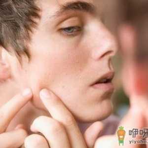男人脸上长痘怎么办 推荐三个祛痘方法