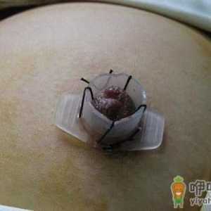 乳头内陷矫正后乳头有敏感度