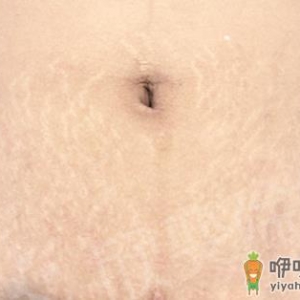激光去妊娠纹的原理