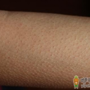 皮肤不平整总起鸡皮疙瘩 教你消鸡皮让皮肤恢复光滑