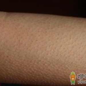 小疙瘩挥之不去的困扰 让皮肤恢复光滑的方法