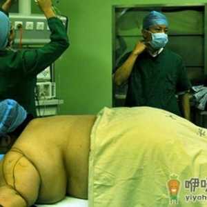 抽脂的5个秘密不可不知道