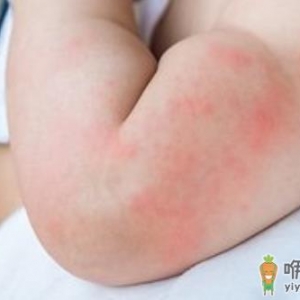 荨麻疹影响生活工作 荨麻疹的治疗方法