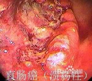 拉屎拉出血怎么回事 无疼痛鲜红色吃什么药