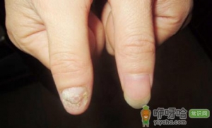 灰指甲根本就治不好吗