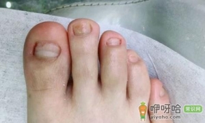 女生得了灰指甲是不是很尴尬