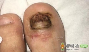 女朋友很漂亮但是有灰指甲怎么办