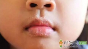 嘴唇疱疹会越来越多吗