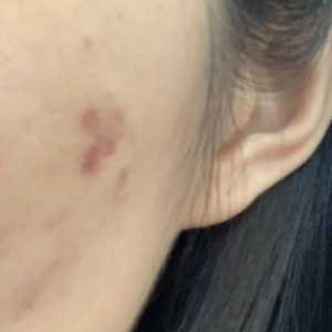 为什么照镜子看不到痘印拍照就有