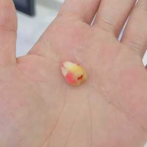 智齿烂了一个洞很痛怎么办