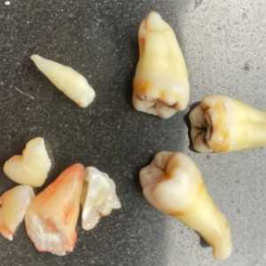一次拔两颗智齿后悔死了