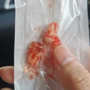 拔智齿48小时刚到立即热敷吗